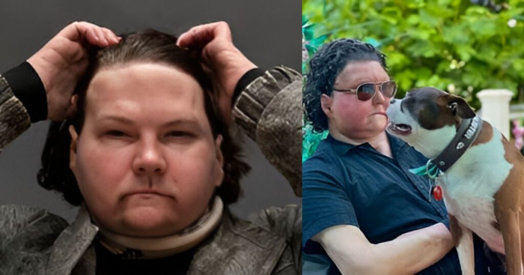 22-Year-Old Undergoes World First Successful Face and Hands Transplant